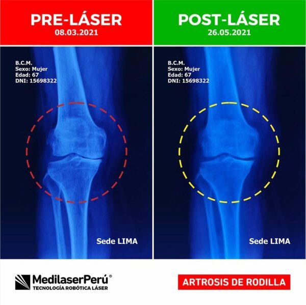 Lazerinis kelio sąnario masažuoklis „KneeCare”